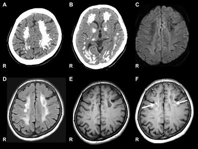 Case report: Mitochondrial trifunctional protein deficiency caused by HADHB gene mutation (c.1175C>T) characterized by higher brain dysfunction followed by neuropathy, presented gadolinium enhancement on brain imaging in an adult patient